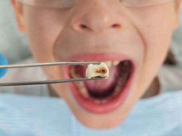 Best Emergency Tooth Extraction in Lake Ketchum, WA