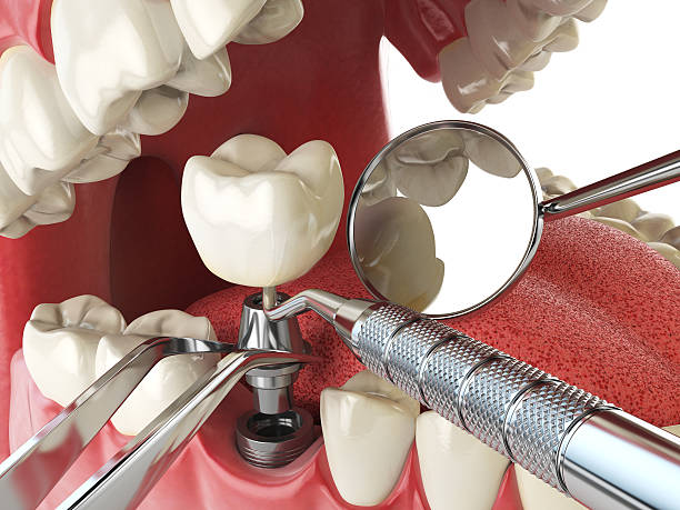 Best Emergency Treatment for Dental Infections or Abscesses in Lake Ketchum, WA